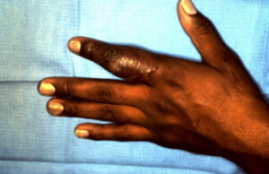 Revascularization Index Finger