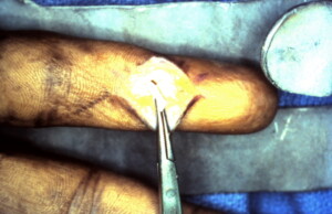 Staged Tendon Reconstruction 