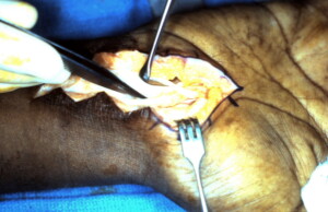 Staged Tendon Reconstruction 