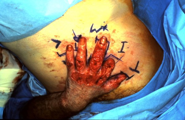louvre flap closure of chemical burn | The Hand Treatment Center - New