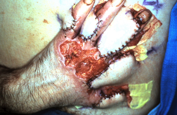 louvre flap closure of chemical burn | The Hand Treatment Center - New